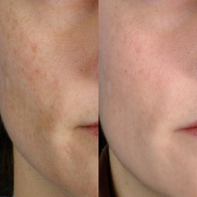 PMD Personal Microderm Clasico